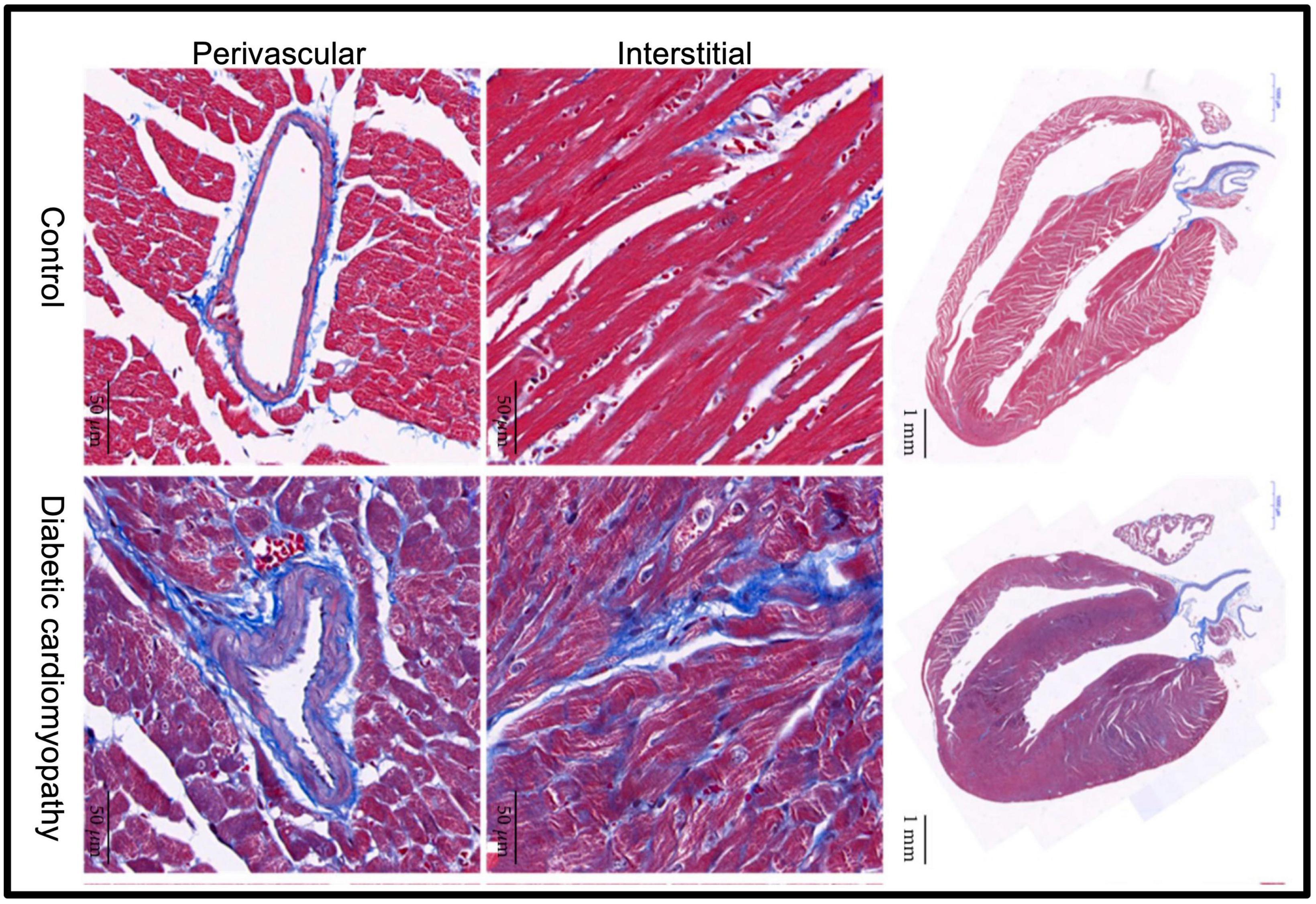 Quantitative MRI in cardiometabolic disease: From conventional cardiac and liver tissue mapping techniques to multi-parametric approaches